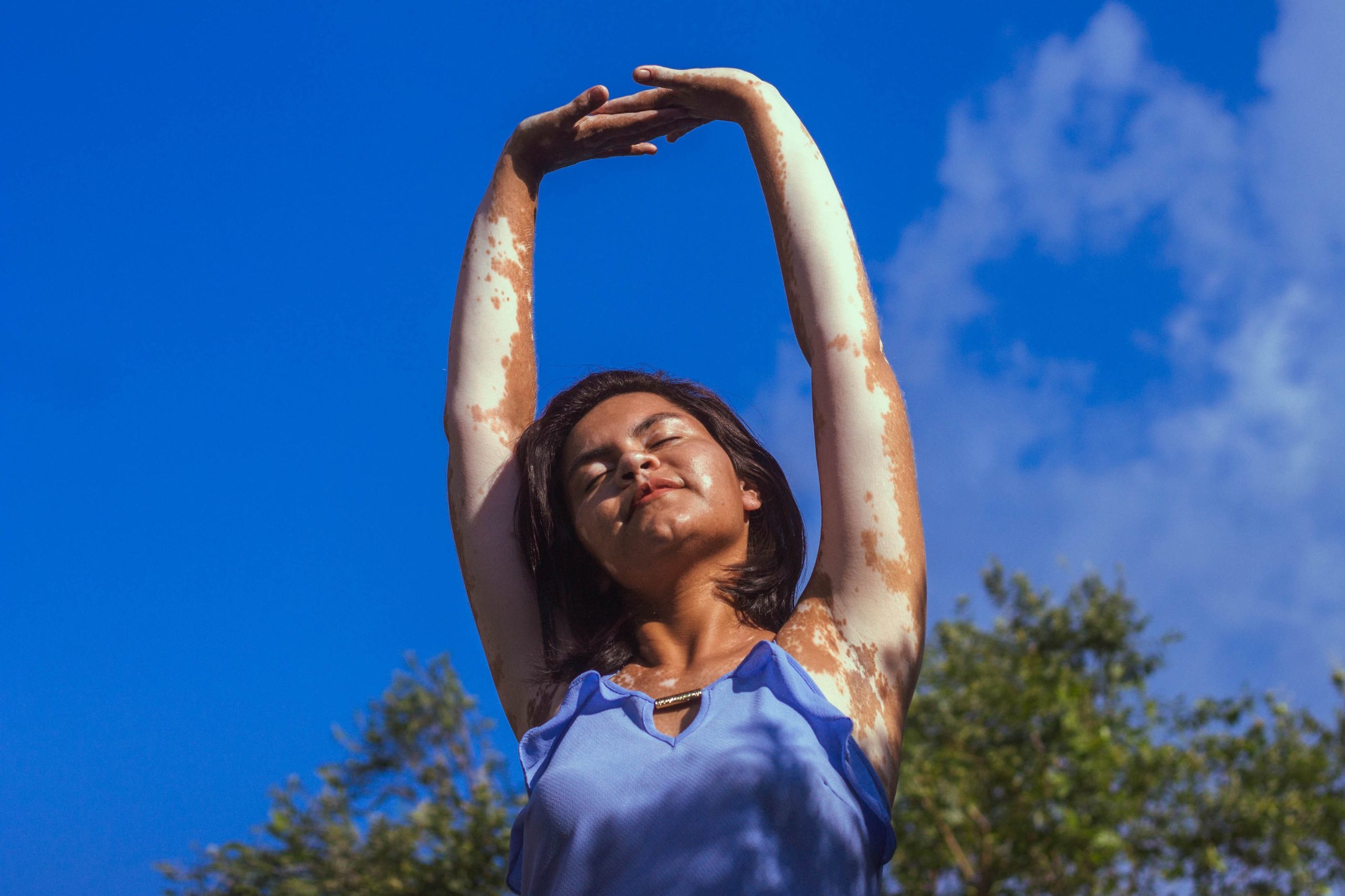 Everything to Know About Vitiligo Symptoms, Causes, and Treatment Options