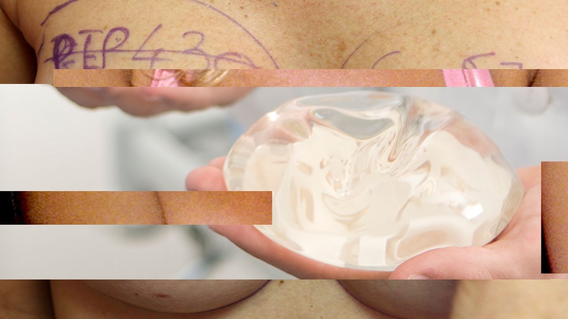 How Breast Implants Have Changed in the Last 30 Years